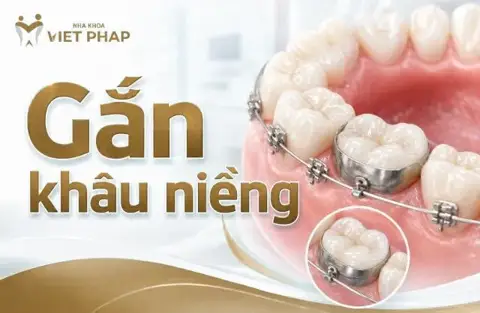 Gắn khâu niềng răng là gì?