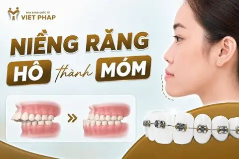 Niềng răng hô có bị thành móm không?