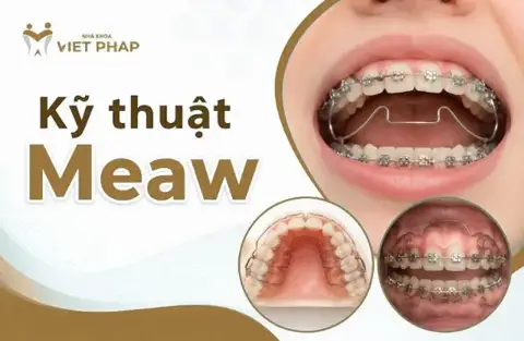 Kỹ thuật MEAW trong chỉnh nha