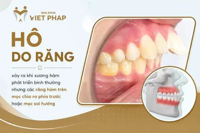 Hô do răng