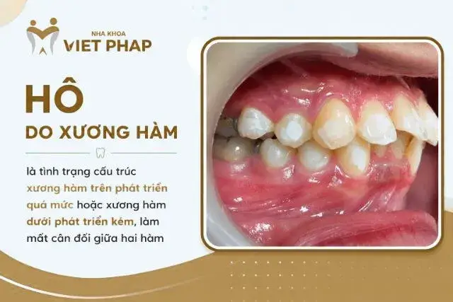 Hô do xương
