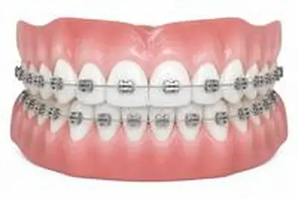 Niềng răng mắc cài tự đóng