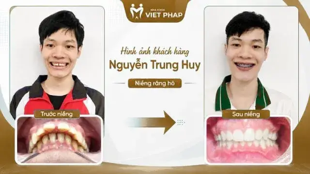 Trước và sau niềng răng hô – KH. Nguyễn Trung Huy