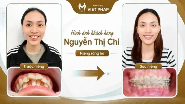 Trước và sau niềng răng hô – KH. Nguyễn Thị Chi