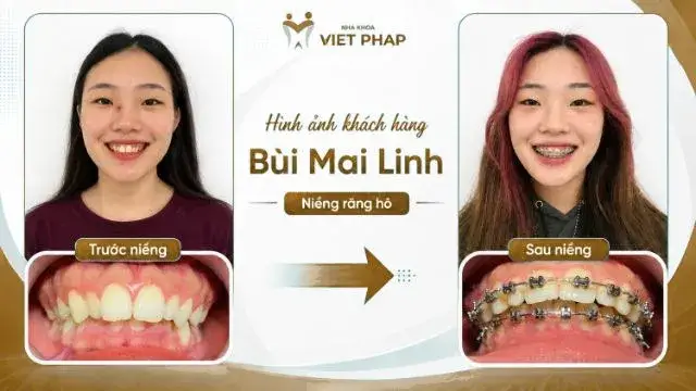 Trước và sau niềng răng hô – KH. Bùi Mai Linh