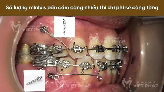 Cắm vít niềng răng có đau không?